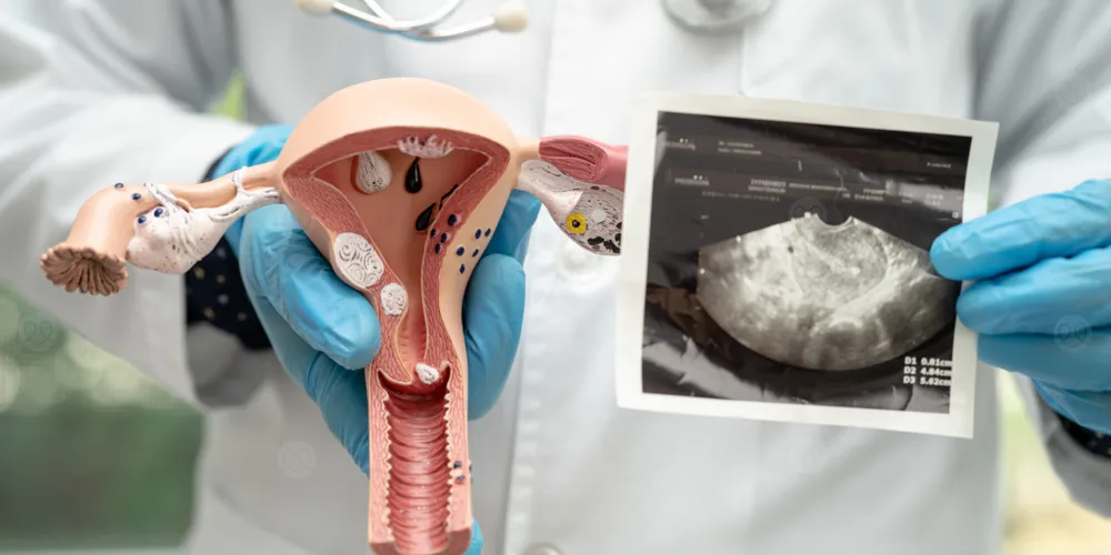 تكيس المبايض والحمل: كيف ترفعين فرص الإنجاب؟