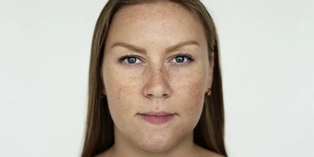 هل تعانين من الكلف؟ 5 حقائق قد تغيّر طريقة تعاملك معه تمامًا