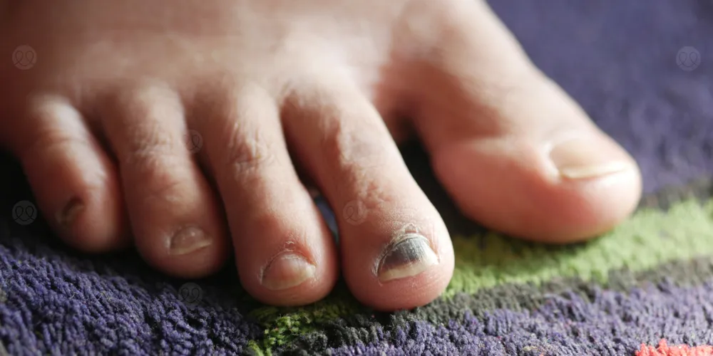 هل تعاني من سواد الأظافر؟ إليك الحل!