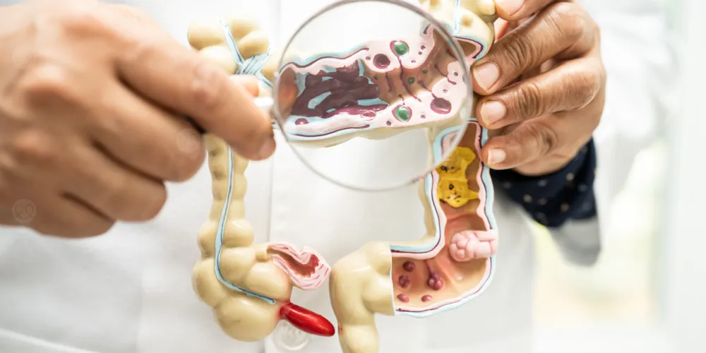 دراسة: فيروسات الأمعاء قد ترتبط بسرطان القولون