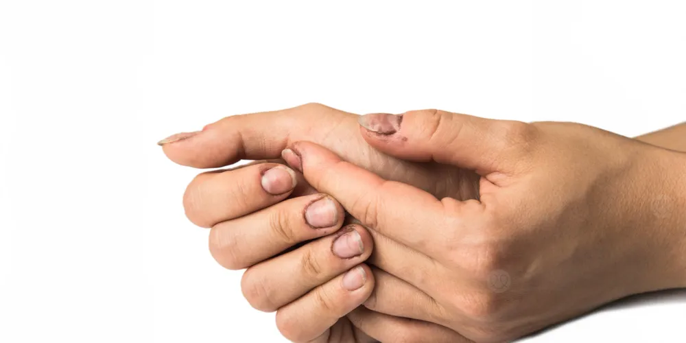 ما هي أسباب الجلد حول الأظافر؟