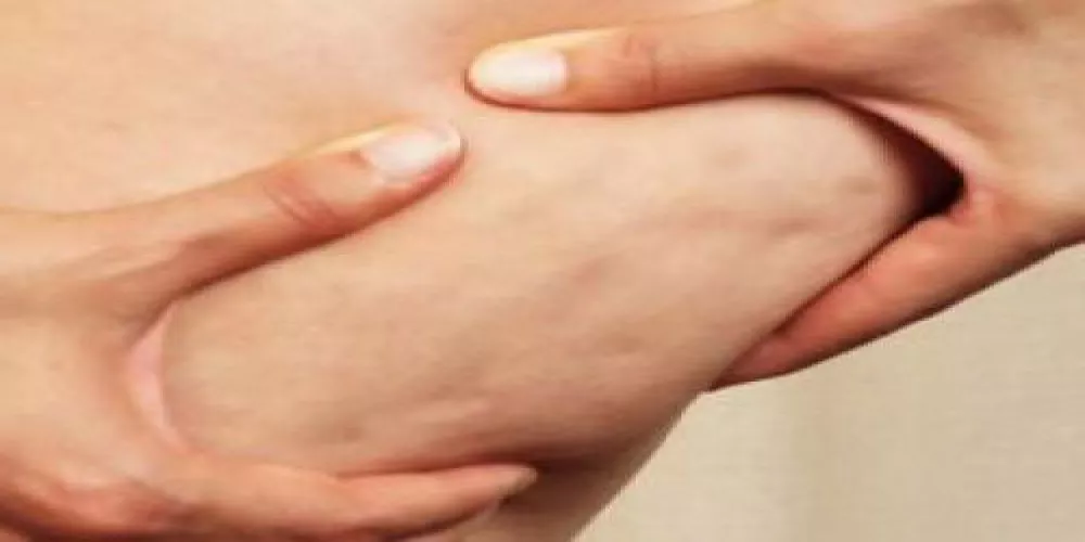 كيف تتجنبين السيلوليت ( الكتل الدهنية المتراكمة) 