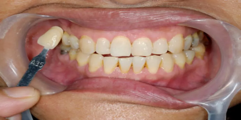 عشرة أشياء يجب أن تعرفها حول تسوس الأسنان