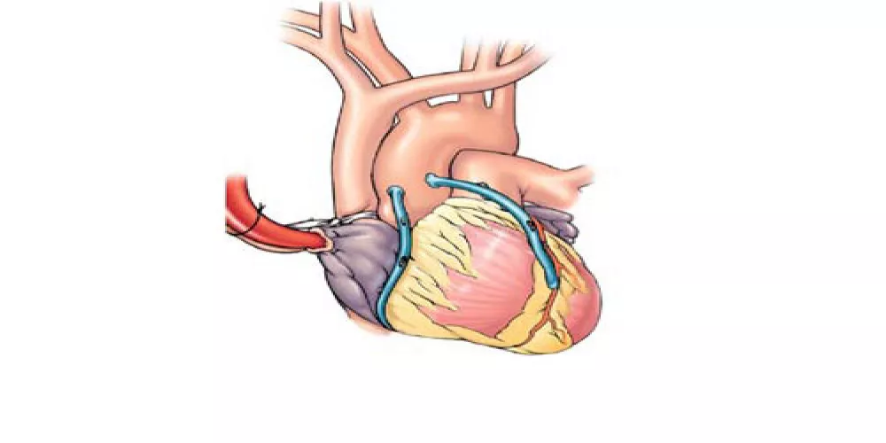 اعطاء الستاتين مباشرة بعد عملية القلب المفتوح لفتح الشريان يقلل الرجفان الأذيني