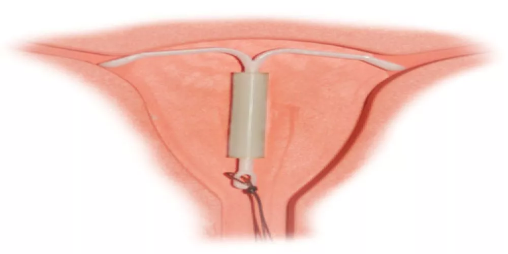 استخدام اللولب مباشره بعد الاجهاض اجراء آمن