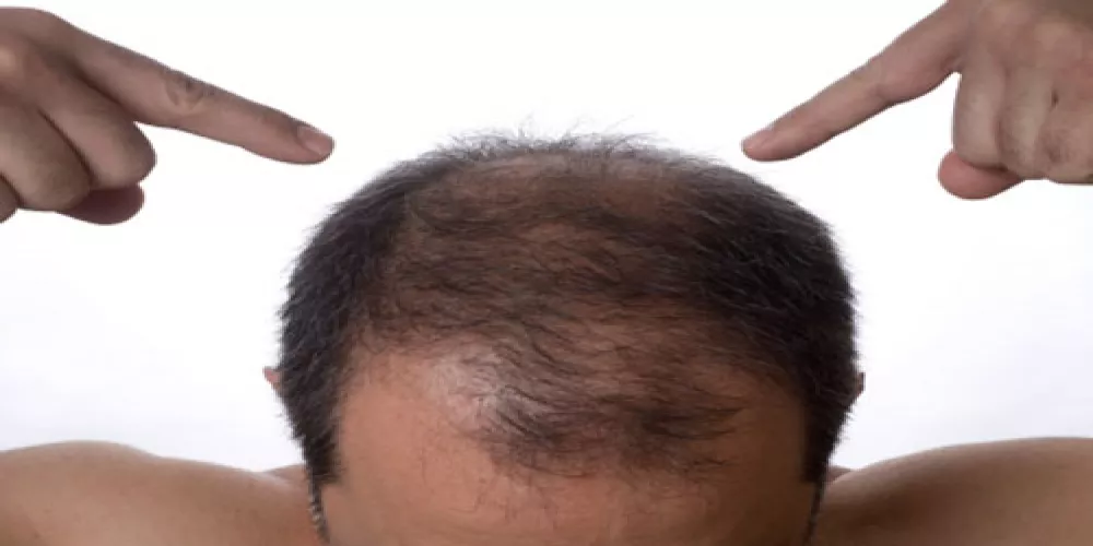 علاج جديد لتساقط الشعر 