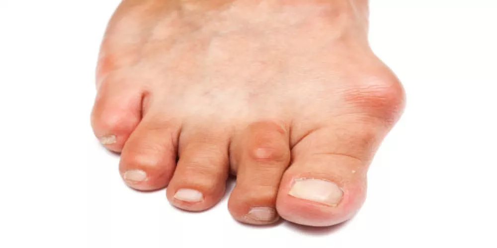 تشوهات اصبع القدم يجب ان تعالج في وقت مبكر