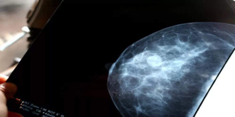 زيادة افراز الاستروجين في انسجة الثدي يزيد خطر الاصابة بالسرطان 