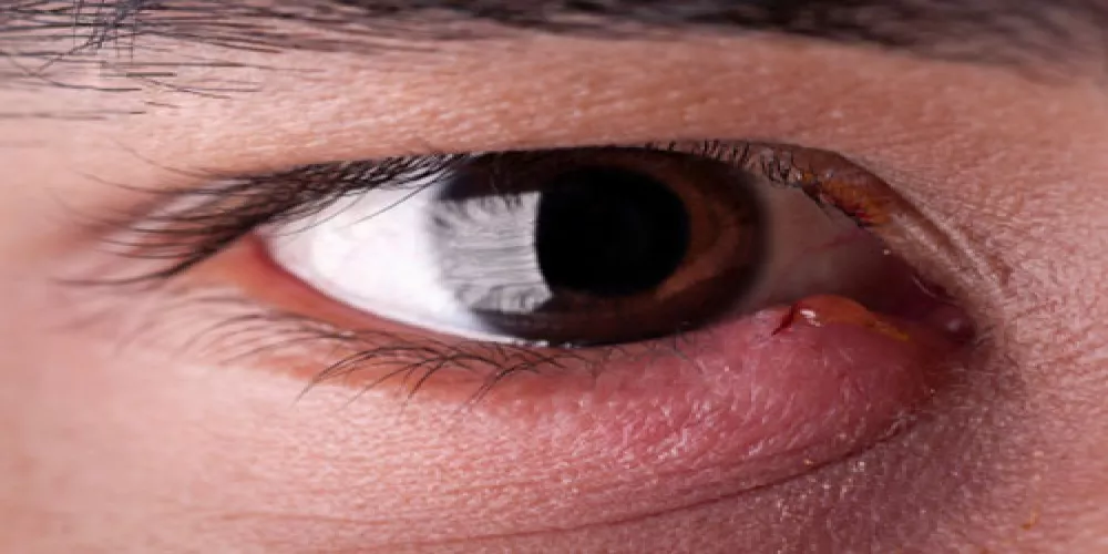 المضادات الحيوية للعيون قد تسبب البكتيريا المقاومة للأدوية 