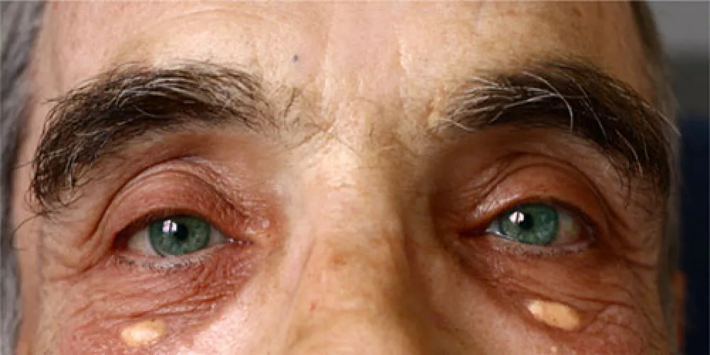 علامات على جفن العين قد تكون مؤشر عل خطر الاصابة بالنوبات القلبية 
