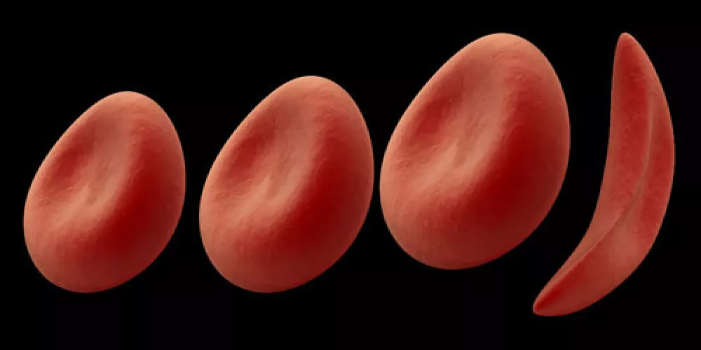 تطوير فحص دم للخلايا المنجلية قد يتوقع شدة المرض  
