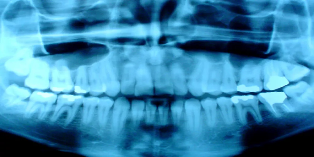 تصوير الأسنان بالأشعة السينية يرتبط بأورام الدماغ