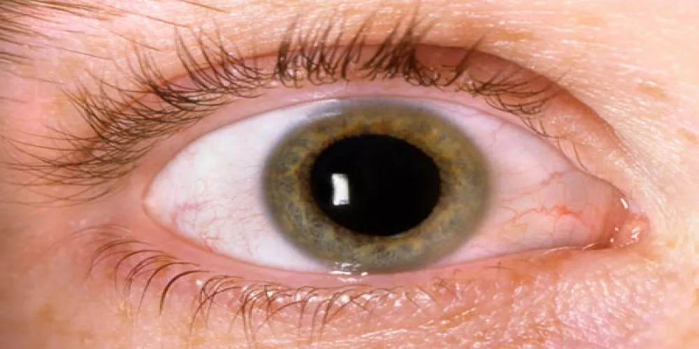 الميتفورمين قد يعالج التهابات العين لمرضى السكري 