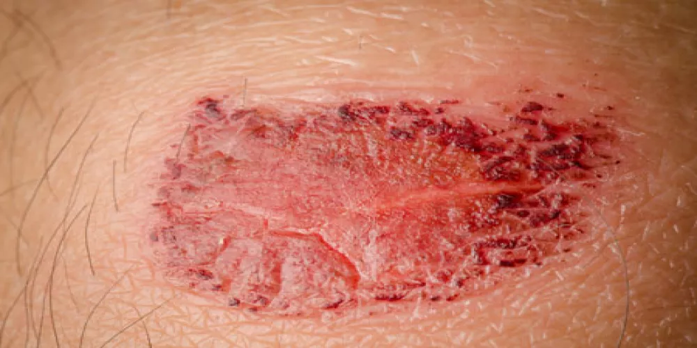 الاصابة بسرطان الجلد يزداد بعد زراعة البنكرياس