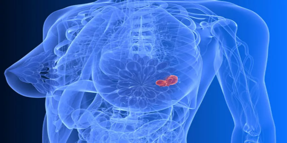  تصوير الثدي الشعاعي ثلاثي الأبعاد يزيد دقة تشخيص سرطان الثدي