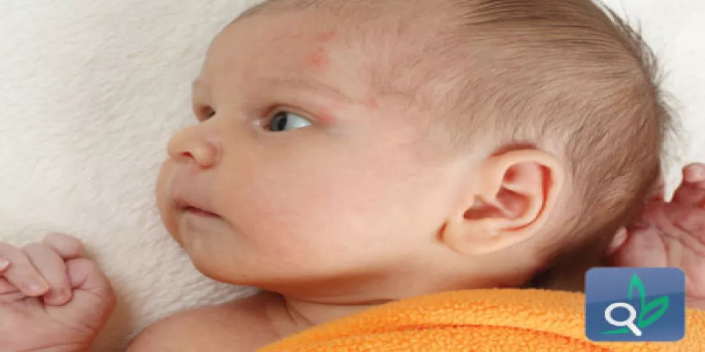 البروبايوتيكس تُقلل من المشاكل الجلدية لدى الطفل الرضيع 