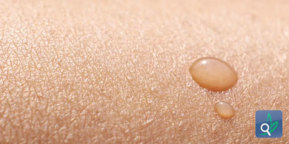 مضاد حيوي في العرق يكافح جراثيم المستشفيات 