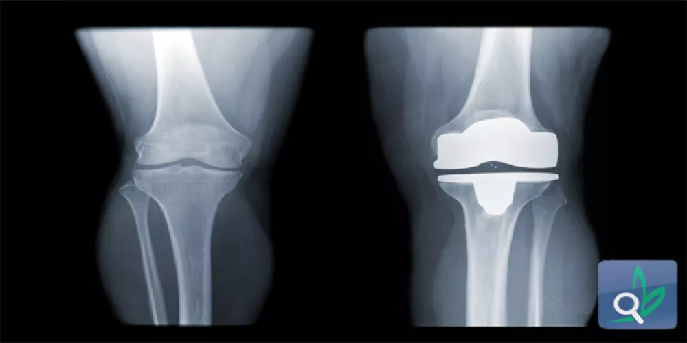 استبدال الركبة لا يؤثرعلى وظائف المرضى  