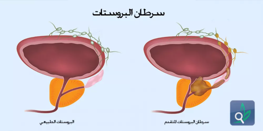 السيلينيوم  يقلل الاصابة بسرطان البروستات المتقدم 