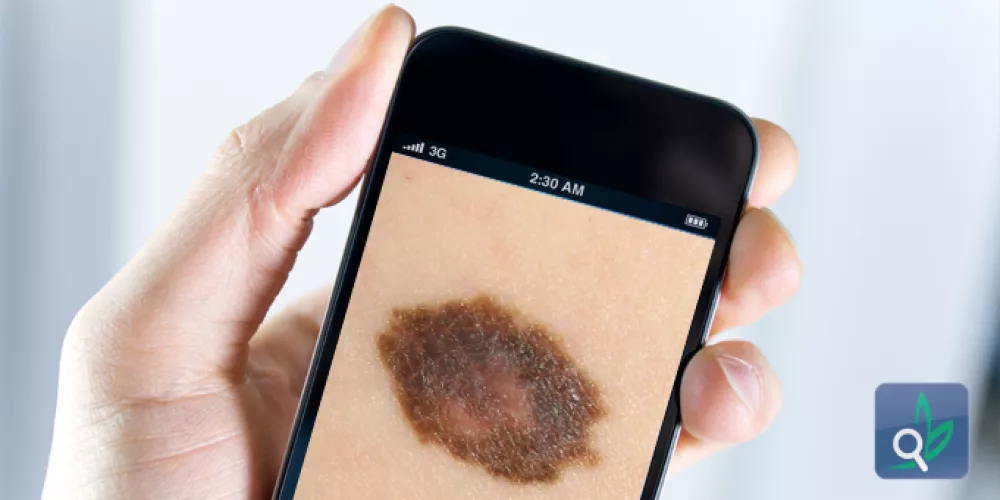 تطبيقات الهواتف الذكية غير دقيقة في تشخيص ورم الجلد الميلانيني