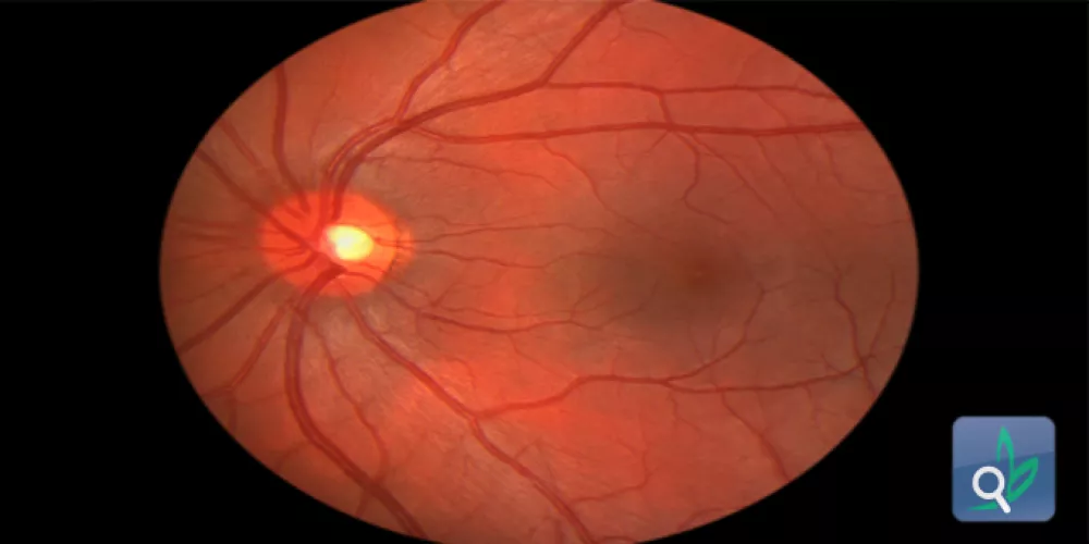 فحص الأوعية الدموية لشبكية العين للتنبؤ بالسكتة الدماغية 