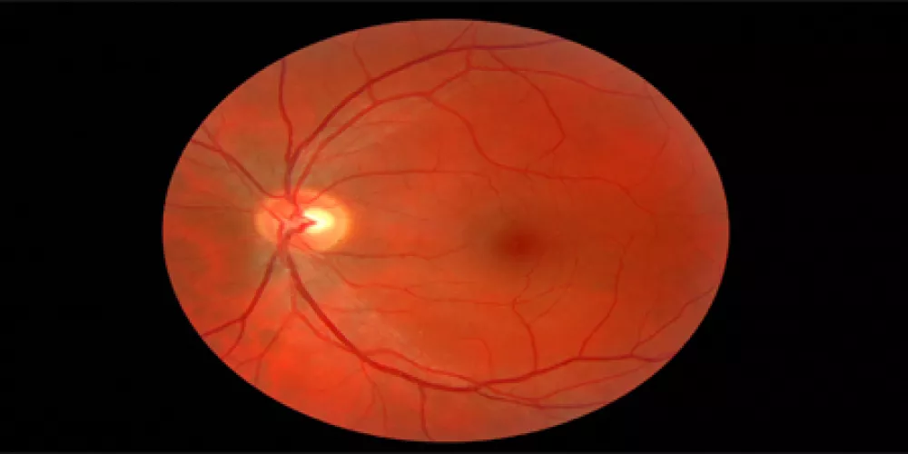 علاج فقدان البصر جينياً 