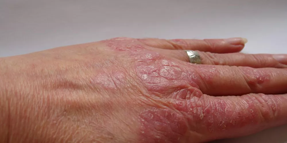 دواء معجزة قد يعالج مرض الصدفية 