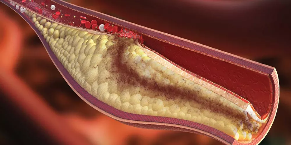 أطعمة لمحاربة الكوليسترول 