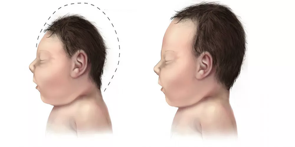 مخاطر جديدة تحيط بالأطفال الذين يولدون بعد تأثير فيروس زيكا