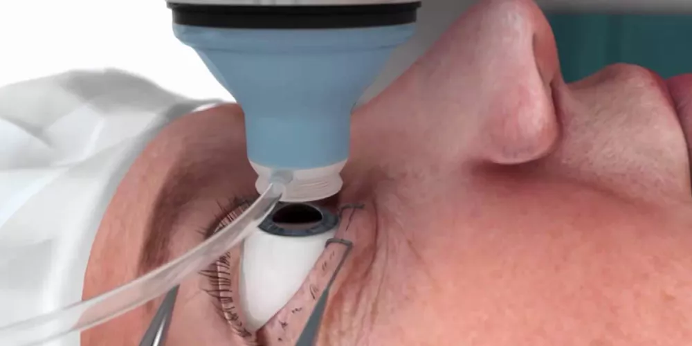 جراحة جديدة باستخدام الليزر تساعد في علاج إعتام عدسة العين