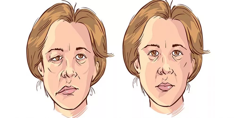 تعرّف على الحالة المرضية النادرة: الوهن العضلي الوبيل (Myasthenia Gravis)