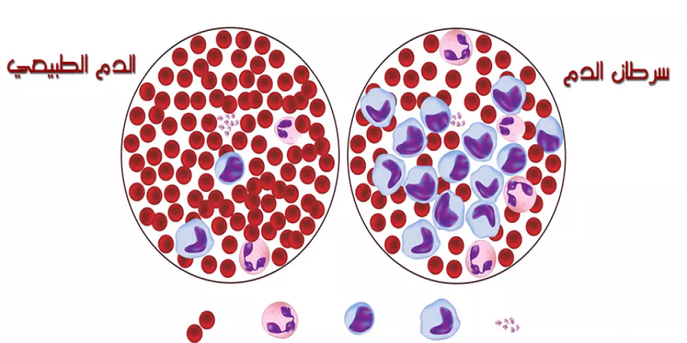 هندسة الخلايا المناعية تؤدي إلى علاج سرطان الدم