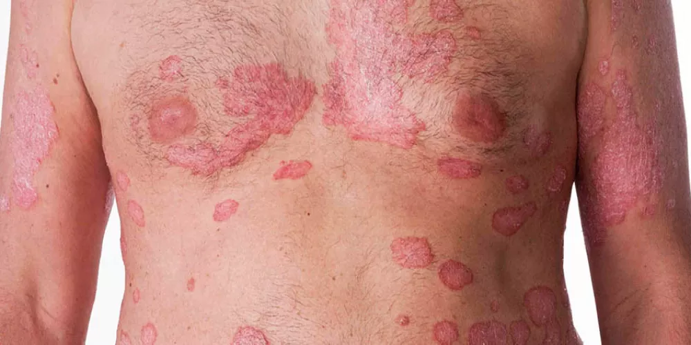 كيف تؤثر الصدفية الجلدية على الحياة الجنسية للرجل؟