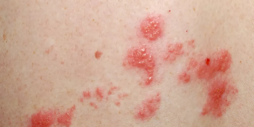 مضاعفات الحزام الناري