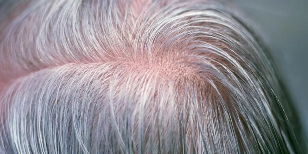 تحديد اسباب الصلع و الشعر الابيض