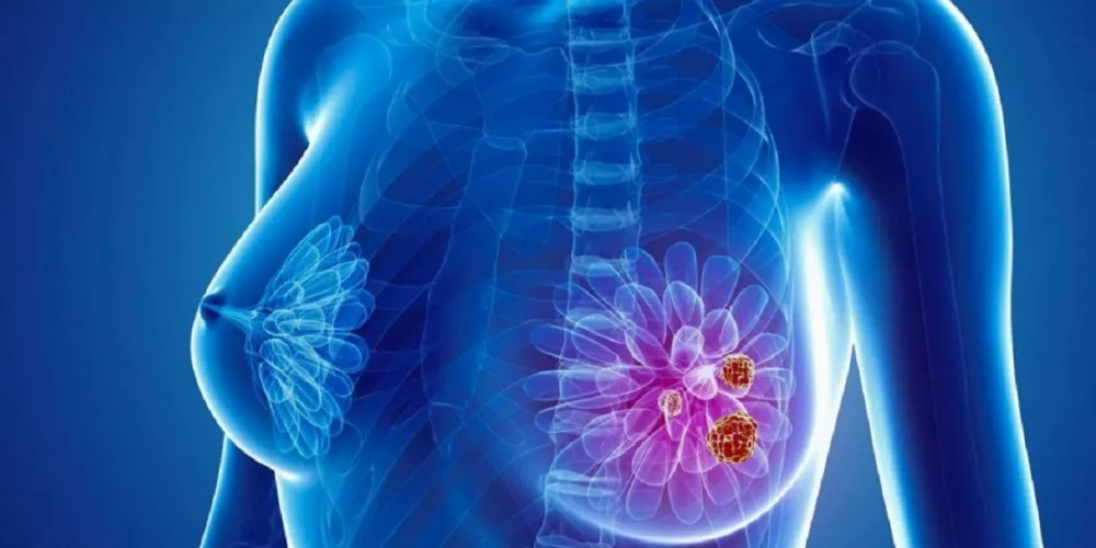 استخدام الضوء في تدمير سرطان الثدي النقيلي