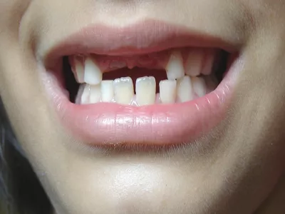 تعويض الاسنان المفقودة