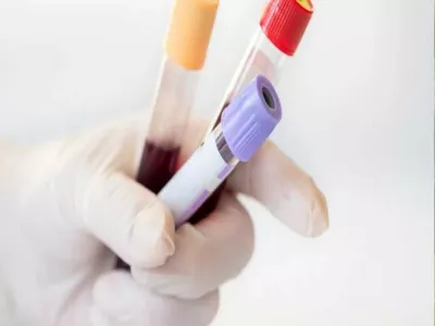 تقنية علاجية للسرطان تشفي من مرض الذئبة