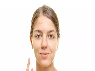 مرض حب الشباب 
