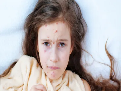 أعراض الحصبة