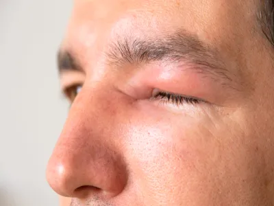 6. دمل العين (Stye)