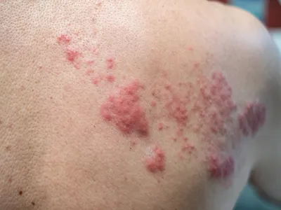5. التهاب الغدد العرقية القيحي (Hidradenitis Suppurativa)