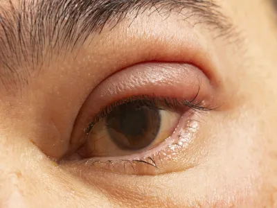 6. انتفاخ حول العين