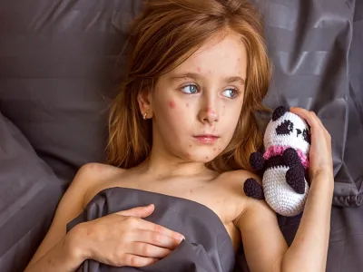 أعراض الحصبة عند الأطفال بالصور: 7 علامات احذرها!