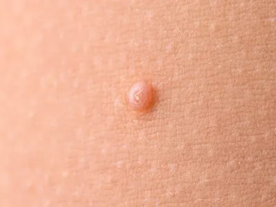 4. الثآليل التناسلية (Genital Warts)