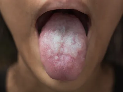 6.  الطلوان أو قروح بيضاء سميكة