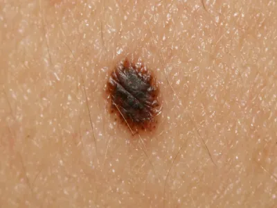 وحمة سبيتز (Spitz nevus)