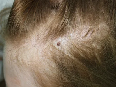 الشامات الخَلقية (Congenital nevi)