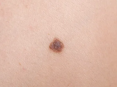 الشامات الميلانينية الوصلية (Junctional melanocytic nevi)