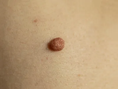 الشامات المُركبة (Compound nevi)